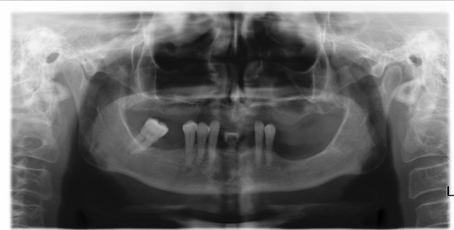 Implantes cigomáticos