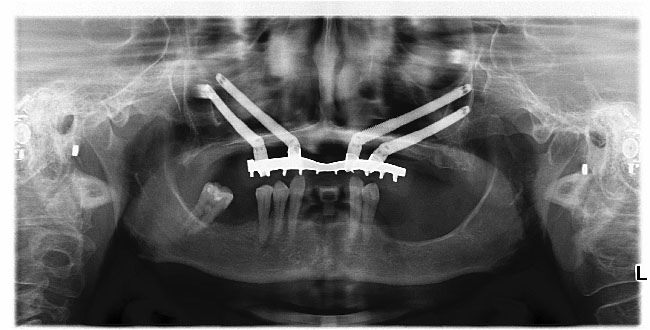 Implantes cigomáticos