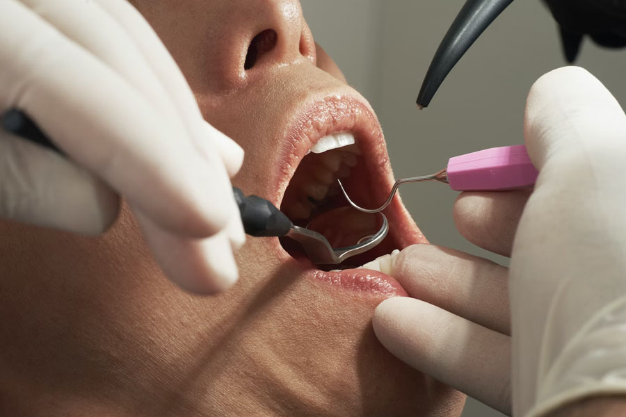 implantes dentales